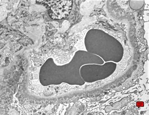 M,69y. | membranous glomerulopathy M,69y. | membranous glomerulopathy